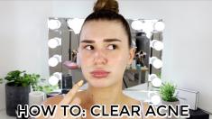 HOW TO CLEAR ACNE ON THE HOLIDAYS | Shani Grimmond