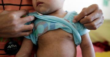 Measles Outbreak: Your Questions Answered