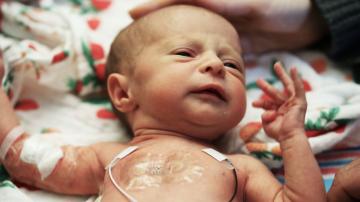 Stick-on sensors will let premature babies get the skin contact they need