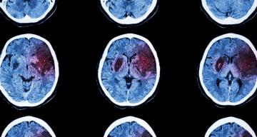 Stroke victims with busy immune responses may also see mental declines
