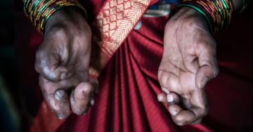 In India, a Renewed Fight Against Leprosy