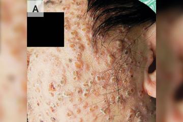 Man’s face erupts in nasty pustules after catching deadly fungal infection