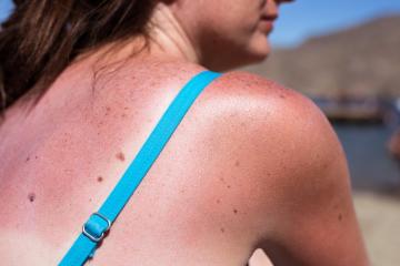 This Is What Happens to Your Body When You Get a Sunburn