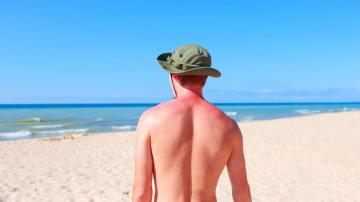 How to Treat a Bad Sunburn