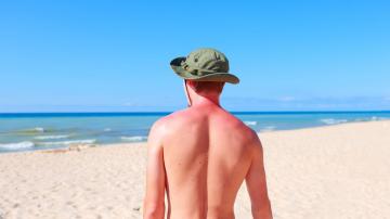 How to Treat a Bad Sunburn