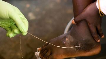 Carter's dream, almost reached: Guinea worm cases drop to 14
