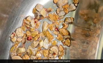 206 Kidney Stones Removed In 1 Hour From 56-Year-Old Hyderabad Man