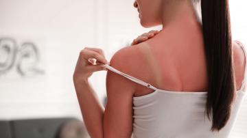 How to Tell If Your Sunburn Might Actually Need Medical Attention