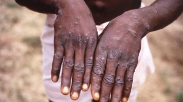 African officials: Monkeypox spread is already an emergency