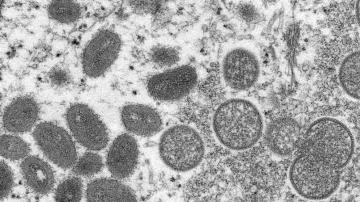 2 children confirmed with monkeypox in US