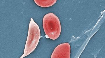 Study: Too few kids with sickle cell get stroke screen, care