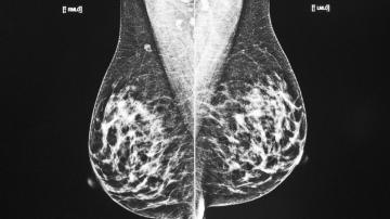 More breast cancer patients can choose smaller surgery
