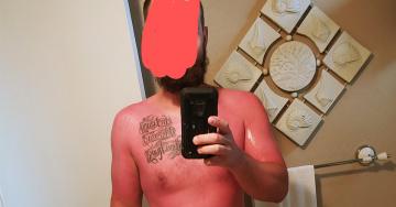 Do your best to avoid sunburn fails like these this Memorial Day weekend (27 Photos)