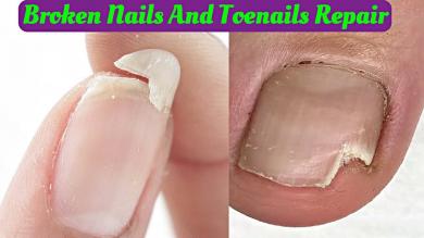 Fixing BROKEN Nails And Toenail Transformation Pedicure Tutorial 