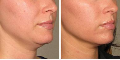 Everything You Need to Know About Laser Skin Tightening