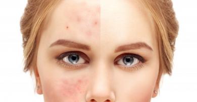 Acne scarring: How fillers could be the solution to pitted scars, Non Surgical Clinic owner Dr Renée Hoenderkamp exclusively explains