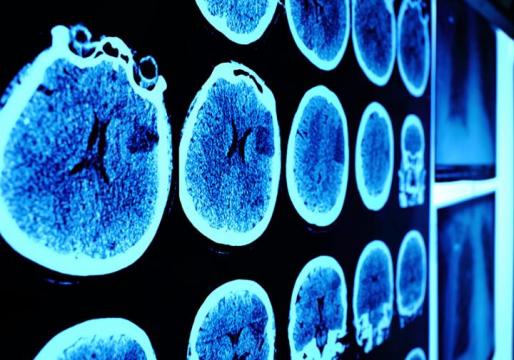 Experimental drug combined with radiation kills brain tumors in pre-clinical studies