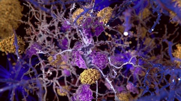 Alzheimer's Study Sparks a New Round of Debate Over the Amyloid Hypothesis