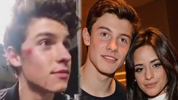 Shawn Mendes Falls & INJURES Face & Might COLLAB With Camila Cabello