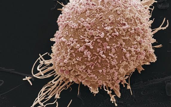 AI-Based App Could Screen for Cervical Cancer  