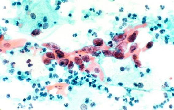 Cervical cancer is more aggressive when human papillomavirus is not detected