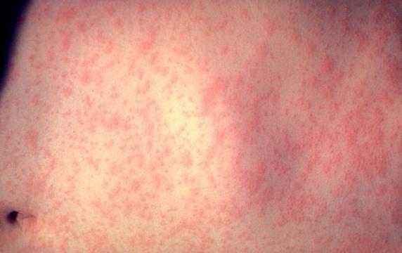 Measles Outbreaks Follow a Predictable Path&mdash;Provided People Get Vaccinated