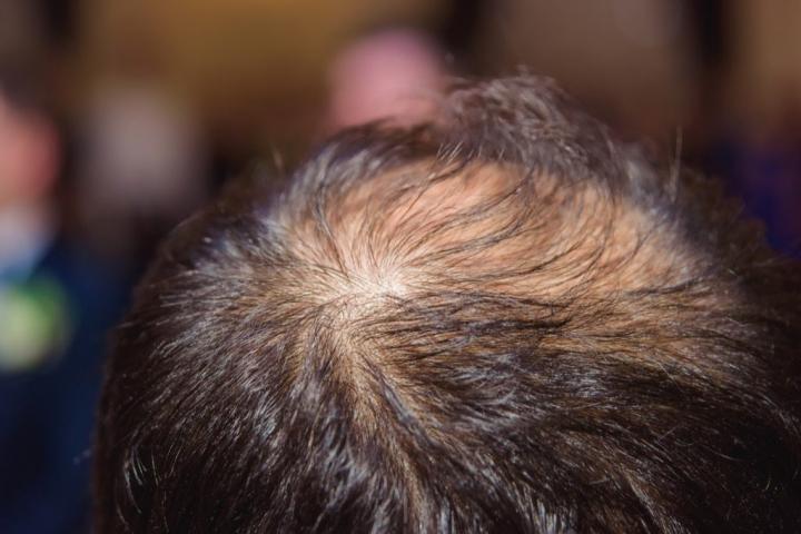 Alopecia-1024x683.jpg