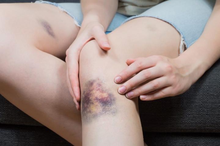 bruise-1-1024x681.jpg
