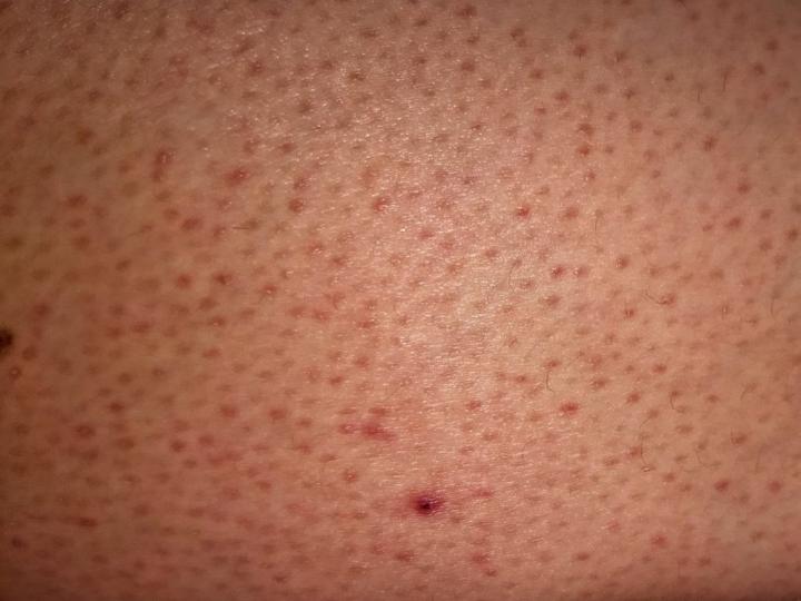 skin-bumps-1024x768.jpg