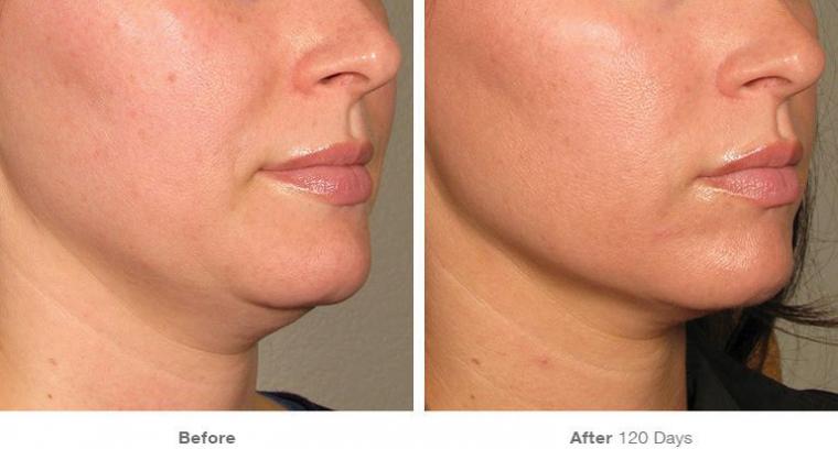 before-after-results-under-chin18-1552334868.jpg?crop=1xw:1xh;center,top&resize=480:*