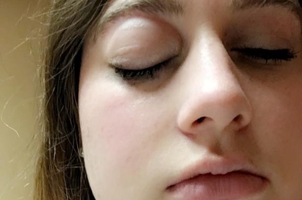 This Viral Tweet About A Severe Nut Allergy Shows Just How Scary Allergic Reactions Can Be