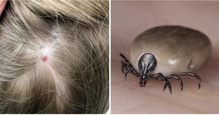A Mother Says Her 5-Year-Old Was Temporarily Paralyzed From A Tick Bite On Her Scalp