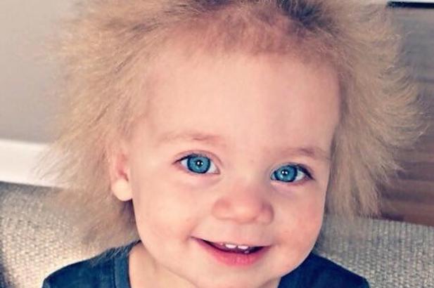 This Toddler Has Uncombable Hair Syndrome And That's A Real Genetic Condition