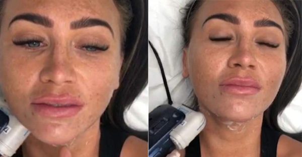Lauren Goodger films herself getting non surgical FACE LIFT as fans plead with her to leave her skin alone