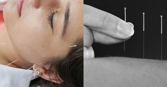 Here's Absolutely Everything You Need To Know About Acupuncture