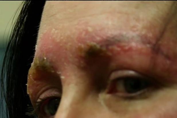 This Woman Got A Horrible Infection After Getting Her Eyebrows Microbladed