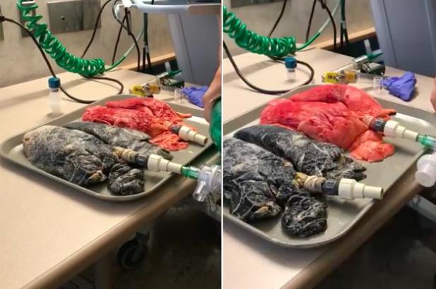 This Horrifying Video Of A Smoker's Lungs Shows Exactly Why You Shouldn't Light Up