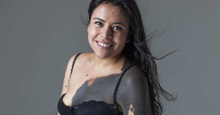 This Woman Is Embracing Her Birthmarks In The Most Beautiful Way