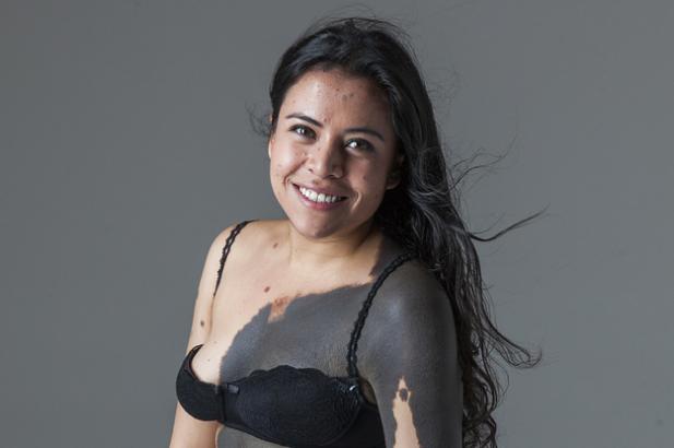 This Woman Is Embracing Her Birthmarks In The Most Beautiful Way