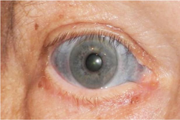 A Man's Eyes Were Stained Blue After He Took An Antibiotic To Treat Inflammation