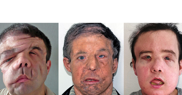 For The First Time In History, A Person Has Undergone Two Face Transplants