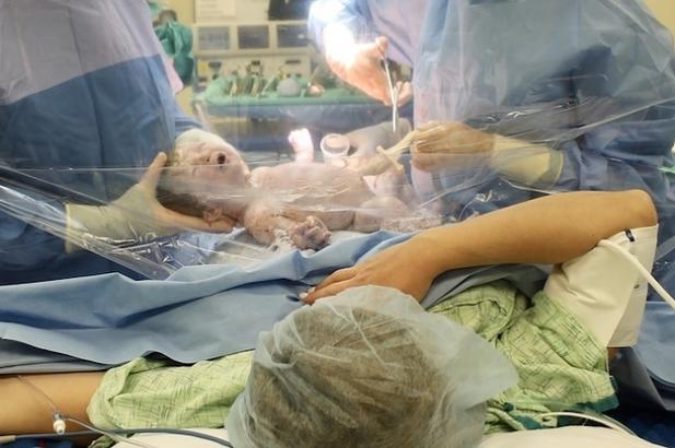 This Mom Saw Her Baby Being Born During A C-Section And Honestly, It's Pretty Cool