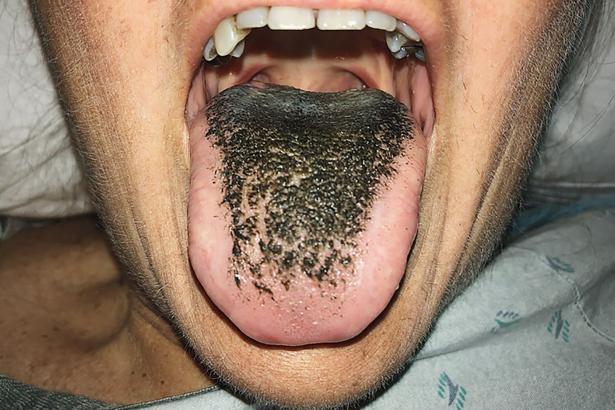 Woman suffers from ‘black hairy tongue’ after car accident