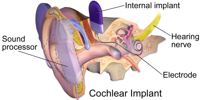 Cochlear Implants