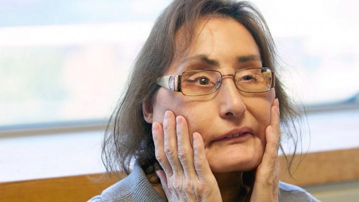 Connie Culp, 1st US partial face transplant recipient, dies