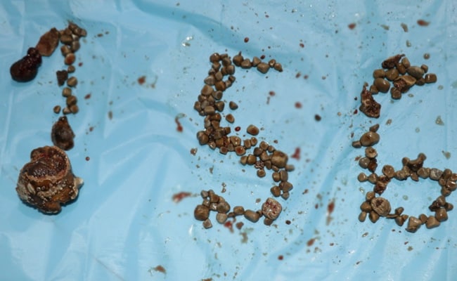 Hyderabad Doctors Remove Record 156 Kidney Stones From Single Patient