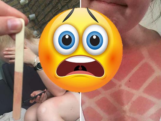 PAINFULLY bad…but hilarious…sunburns (28 Photos)