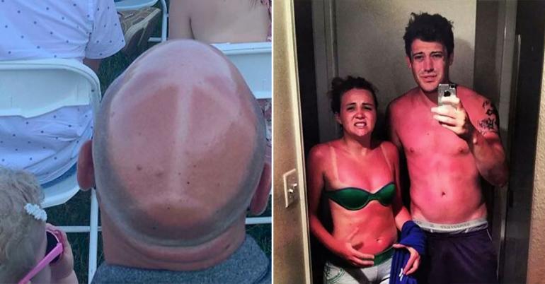 Painful sunburns that are in desperate need of some aloe (30 Photos)