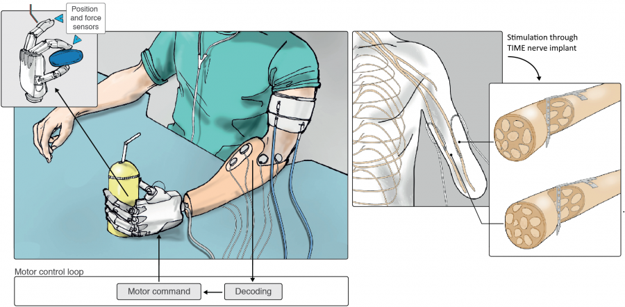 prosthetic_diagram.png